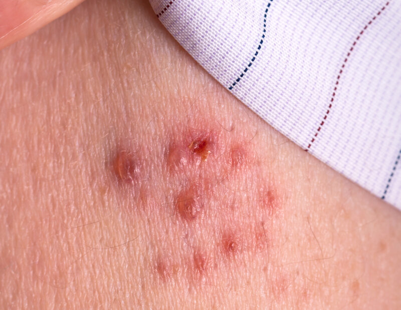 Protect yourself from shingles! - Sneed Medical